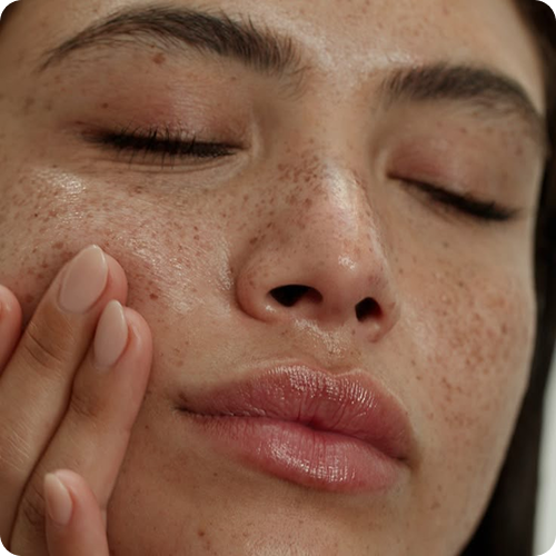 Imagem ilustrativa do procedimento Protocolos em Geral (acne, melasma, clareamento)